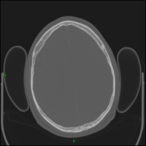Cerebral contusions (Radiopaedia 33868-35039 Axial bone window 149).jpg