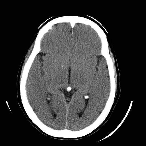 File:Cerebral edema (evolution in time) (Radiopaedia 19418-19440 non-contrast 52).jpg