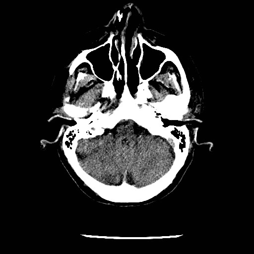 File:Cerebral edema (evolution in time) (Radiopaedia 19418-19441 non-contrast 21).jpg