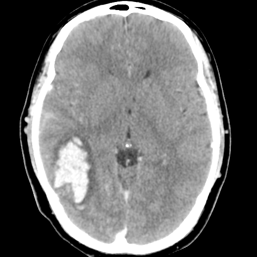 Cerebral hemorrhage secondary to arteriovenous malformation (Radiopaedia 33497-34561 B 26).png