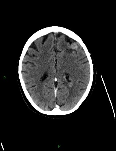 Cerebral metastases - ependymal and parenchymal (Radiopaedia 79877-93131 Axial C+ delayed 56).jpg