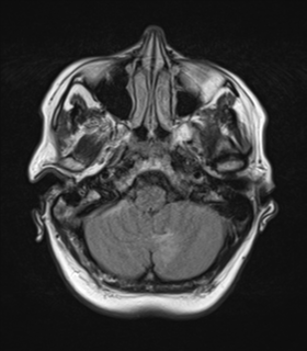 File:Cerebral metastases mimicking abscesses (Radiopaedia 45841-50131 Axial FLAIR 6).png