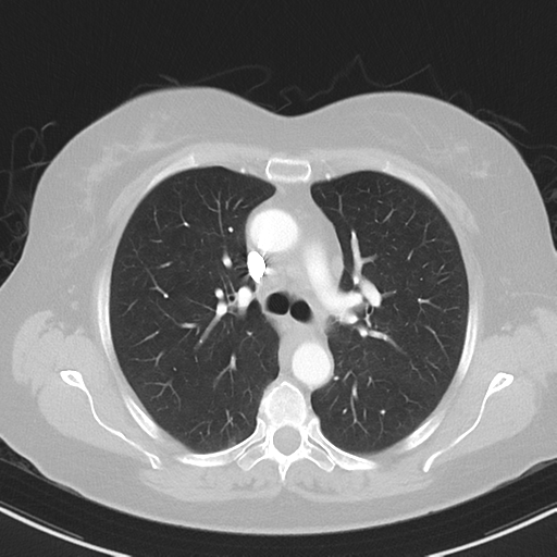 File:Cerebral metastasis mimicking glioblastoma (Radiopaedia 69155-78938 Axial lung window 16).png
