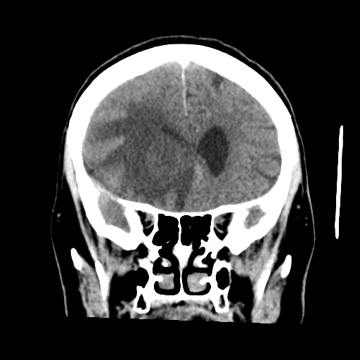 Cerebral metastasis to basal ganglia (Radiopaedia 81568-95412 Coronal C+ delayed 21).png
