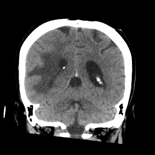 Cerebral metastasis to basal ganglia (Radiopaedia 81568-95412 Coronal non-contrast 46).png