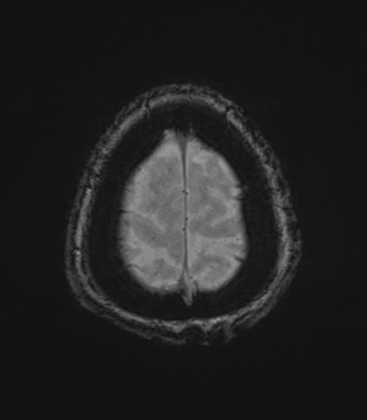 Cerebral metastasis to basal ganglia (Radiopaedia 81568-95413 Axial SWI magnitude 81).png