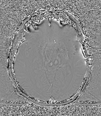 Cerebral metastasis to basal ganglia (Radiopaedia 81568-95413 Axial SWI phase 37).png