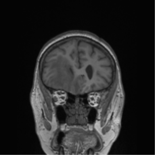 Cerebral metastasis to basal ganglia (Radiopaedia 81568-95413 Coronal T1 48).png