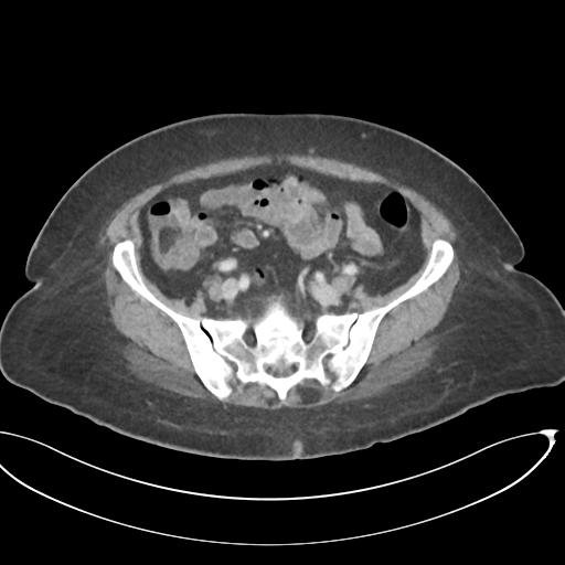 File:Cerebral metastasis to basal ganglia (Radiopaedia 81568-95414 E 56).png