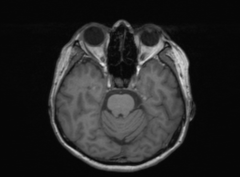Cerebral ring enhancing lesions - cerebral metastases (Radiopaedia 44922-48817 Axial T1 276).jpg