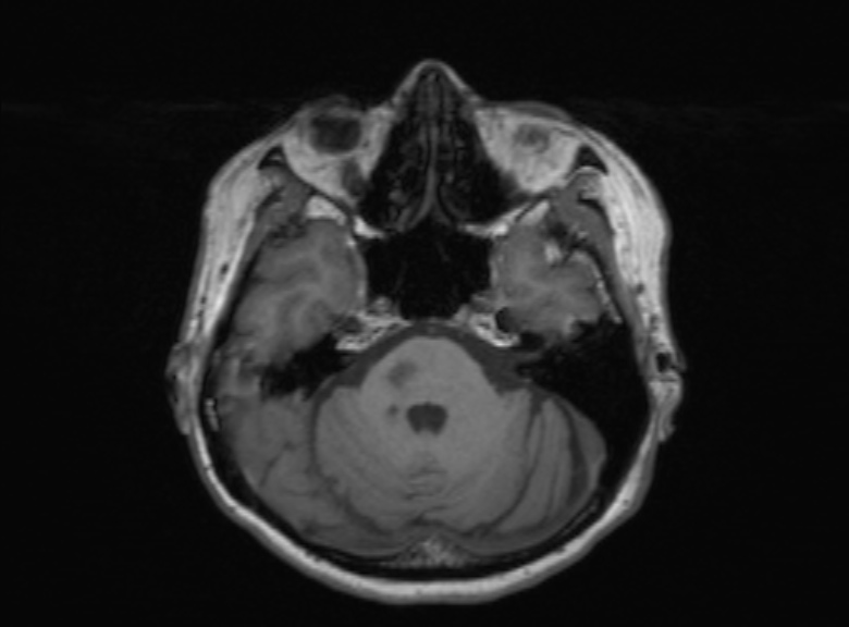 Cerebral ring enhancing lesions - cerebral metastases (Radiopaedia 44922-48817 Axial T1 292).jpg