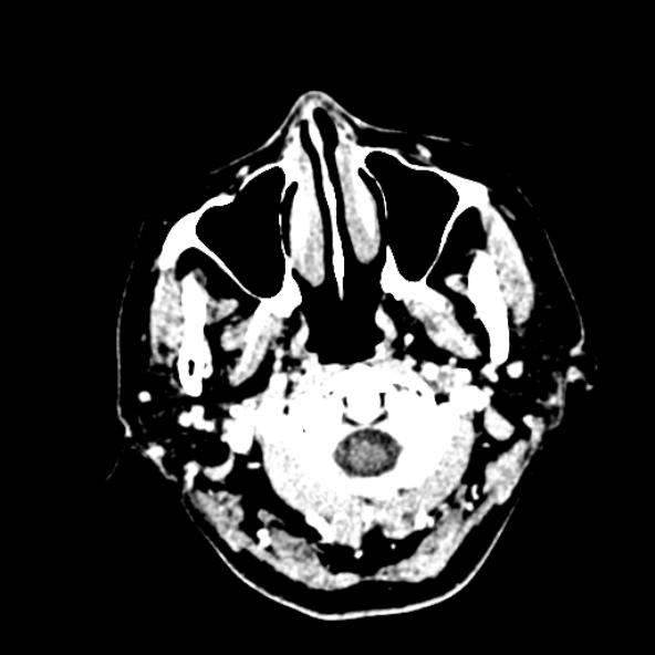 Cerebral ring enhancing lesions - cerebral metastases (Radiopaedia 44922-48818 B 1).jpg