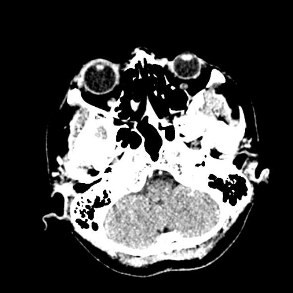 Cerebral ring enhancing lesions - cerebral metastases (Radiopaedia 44922-48818 B 52).jpg