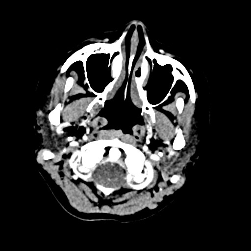 Cerebral tuberculosis with dural sinus invasion (Radiopaedia 60353-68019 Axial C+ delayed 2).jpg