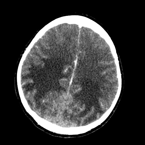 Cerebral tuberculosis with dural sinus invasion (Radiopaedia 60353-68019 Axial C+ delayed 45).jpg