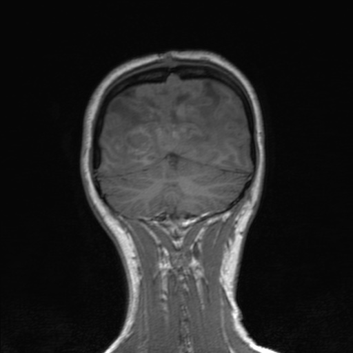 Cerebral tuberculosis with dural sinus invasion (Radiopaedia 60353-68090 Coronal T1 149).jpg