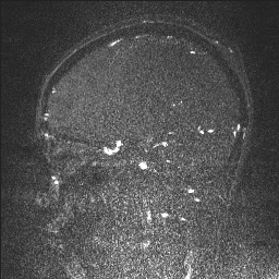 Cerebral tuberculosis with dural sinus invasion (Radiopaedia 60353-68090 Sagittal MRV 54).jpg