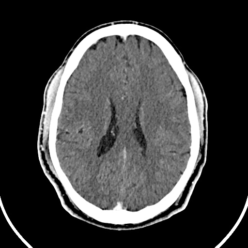 Cerebral venous angioma (Radiopaedia 69959-79977 B 61).jpg
