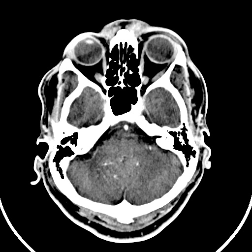 File:Cerebral venous angioma (Radiopaedia 69959-79977 B 8).jpg