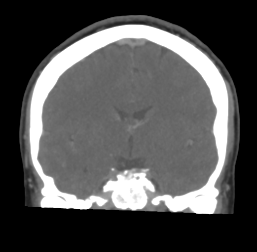 File:Cerebral venous infarct related to dural venous sinus thromboses (Radiopaedia 35292-36804 Coronal C+ delayed 29).png