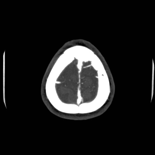 Cerebral venous sinus thrombosis (Radiopaedia 40619-43227 A 213).jpg