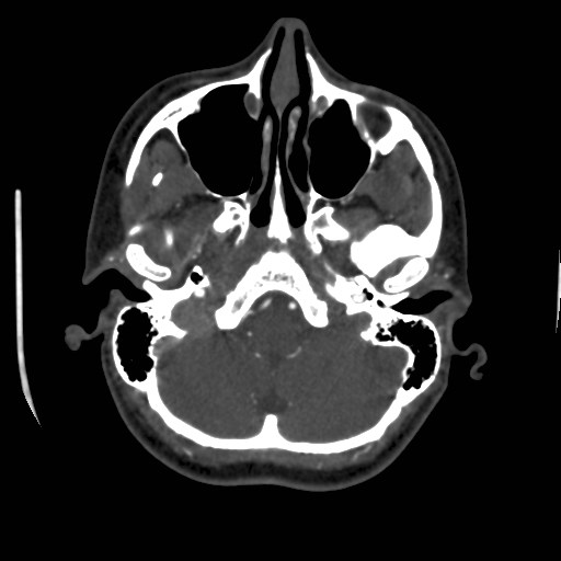 Cerebral venous sinus thrombosis (Radiopaedia 40619-43227 A 39).jpg