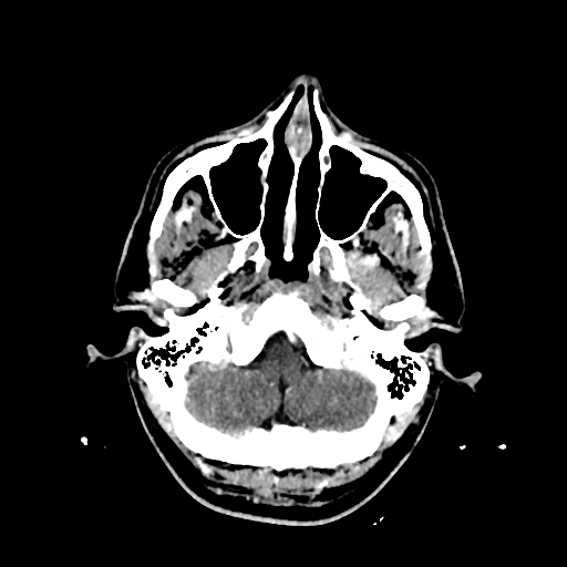 File:Cerebral venous thrombosis (CVT) (Radiopaedia 77524-89685 Axial with contrast 6).jpg