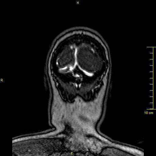 Cerebral venous thrombosis (Radiopaedia 23288-23351 MRV 170).JPG