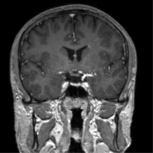 Cerebral venous thrombosis (Radiopaedia 38392-40469 Coronal T1 C+ 52).png