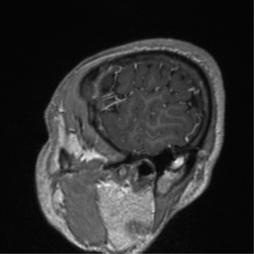 Cerebral venous thrombosis (Radiopaedia 38392-40469 Sagittal T1 C+ 15).png