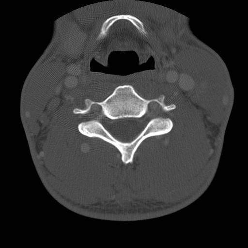 Cervical Pott disease (Radiopaedia 20374-20286 Axial bone window 85).jpg