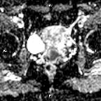File:Cervical adenocarcinoma (Radiopaedia 65011-73985 Axial ADC 14).jpg