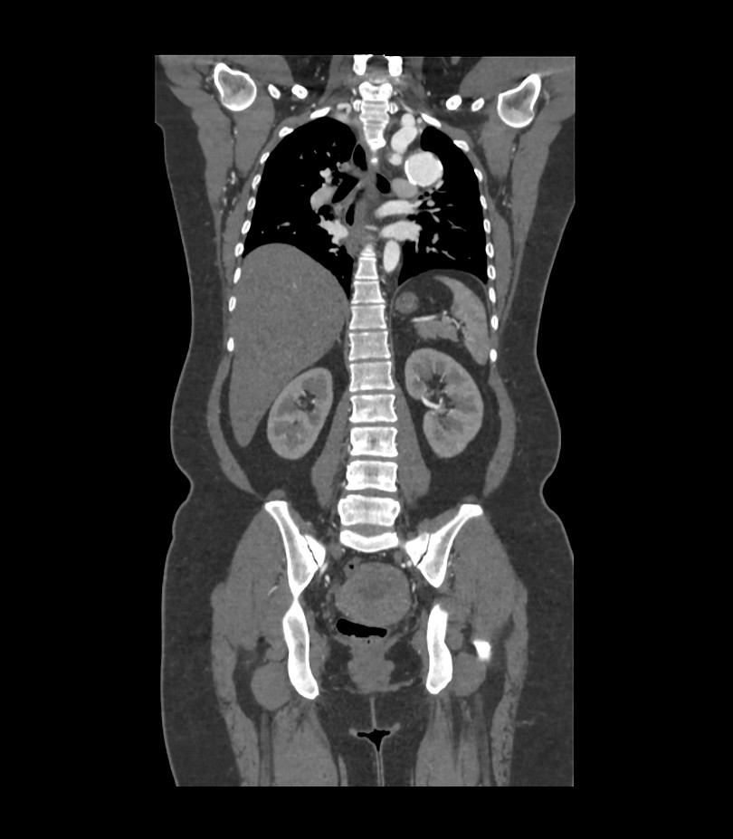 Cervical aortic arch with coarctation and aneurysms (Radiopaedia 44035-47552 C 17).jpg