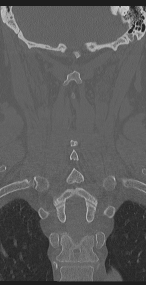 Cervical canal stenosis due to ossification of the posterior longitudinal ligament (Radiopaedia 47260-51823 Coronal bone window 45).png