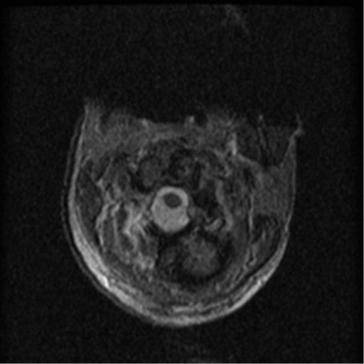 Cervical canal stenosis with cord compression (Radiopaedia 34114-35374 Axial Gradient Echo 91).png