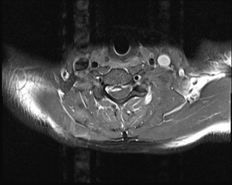 File:Cervical disc extrusion (Radiopaedia 53950-60077 Axial T1 C+ fat sat 18).jpg