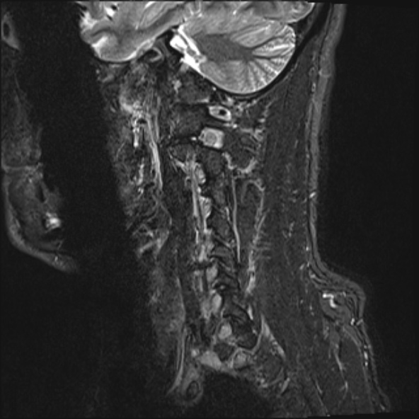 File:Cervical disc extrusion (Radiopaedia 53950-60077 Sagittal STIR 4).jpg