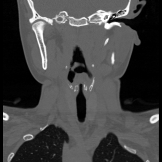 File:Cervical rib (Radiopaedia 71110-81363 Coronal non-contrast 33).jpg
