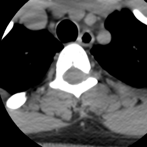 Cervical schwannoma (Radiopaedia 57979-64974 Axial non-contrast 68).png
