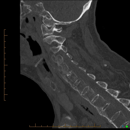 Cervical spine fracture - ankylosing spondylitis (Radiopaedia 76835-88706 Sagittal bone window 46).jpg
