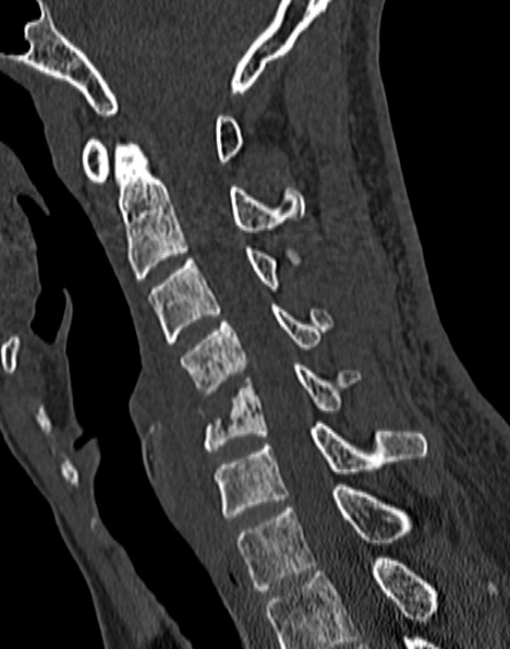 File:Cervical spondylodiscitis (Radiopaedia 28057-29489 Sagittal bone window 36).jpg