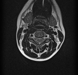 File:Cervical spondylodiscitis and calvarial hemangioma (Radiopaedia 64317-73104 Axial T2 3).jpg