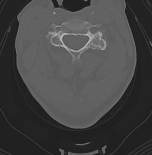 Cervical spondylolysis (Radiopaedia 49616-54811 Axial bone window 27).png