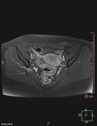 File:Cesarian scar endometriosis (Radiopaedia 68495-78066 Axial T1 C+ fat sat 11).jpg