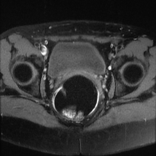 File:Cesarian section scar endometriosis (Radiopaedia 66520-75799 Axial T1 fat sat 18).jpg