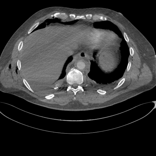 File:Chest multitrauma - aortic injury (Radiopaedia 34708-36147 A 236).png