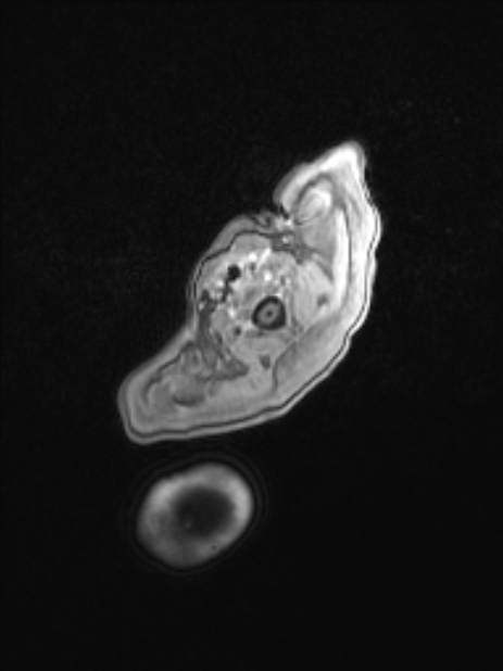 Chiari III malformation with occipital encephalocele (Radiopaedia 79446-92559 Axial T1 C+ mpr 10).jpg