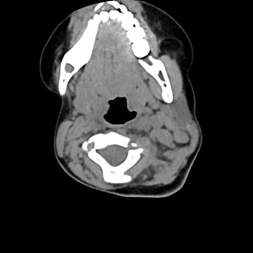 Chiari I with syrinx and skull base anomalies (Radiopaedia 89444-106412 Axial non-contrast 66).jpg