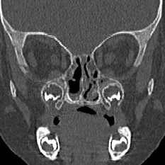 Choanal atresia (Radiopaedia 88525-105975 Coronal bone window 52).jpg