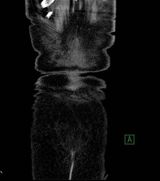 Cholangiocarcinoma with cerebral metastases (Radiopaedia 83519-98629 G 82).jpg